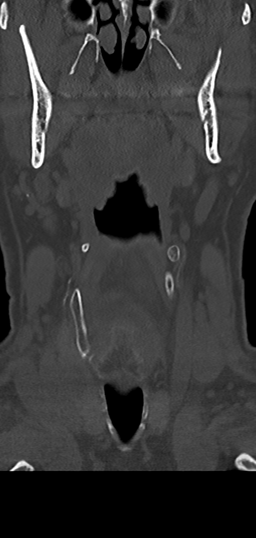 Cervical spine fracture - chalk stick (Radiopaedia 39116-41323 Coronal bone window 7).png