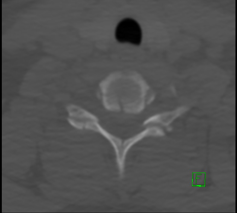 Cervical spine fracture - hyperflexion injury (Radiopaedia 66184-75364 Axial bone window 42).jpg