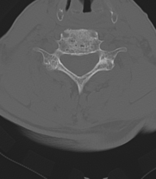Cervical spine fractures with vertebral artery dissection (Radiopaedia 53296-59268 Axial bone window 36).png
