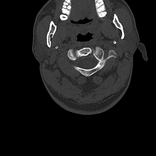 File:Cervical spine trauma with tear drop fracture and perched facet joint (Radiopaedia 53989-60127 Axial bone window 23).jpg