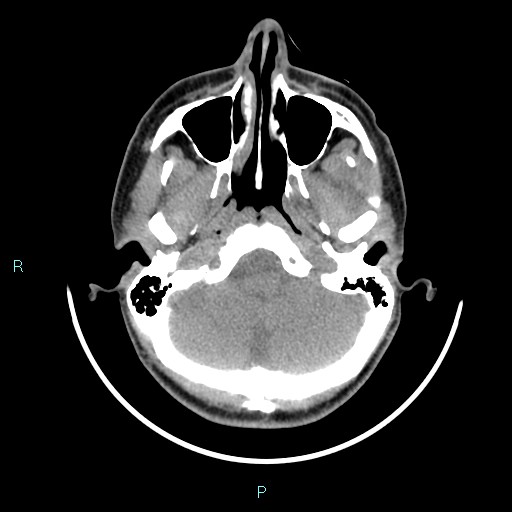 File:Cervical thymic cyst (Radiopaedia 88632-105335 Axial non-contrast 106).jpg