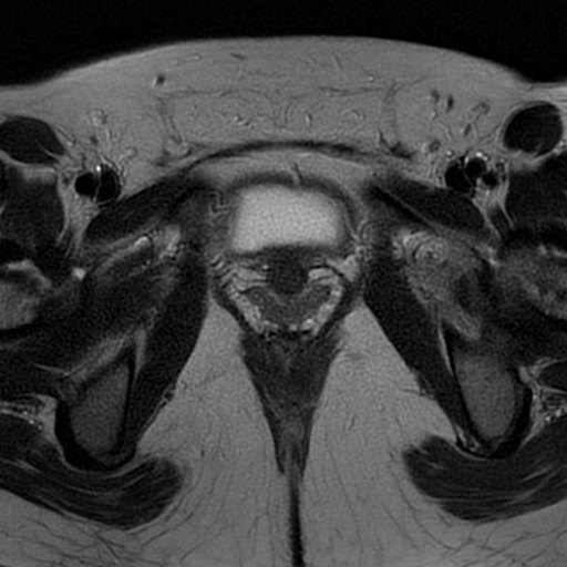 File:Cesarean scar ectopic pregnancy (Radiopaedia 77286-89362 Axial T2 31).jpg
