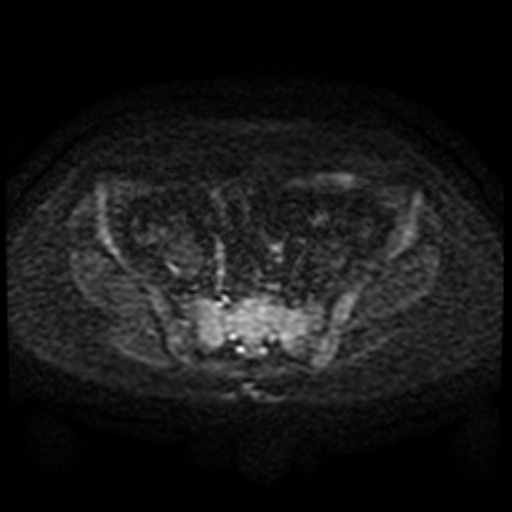 Cesarian section scar endometriosis (Radiopaedia 66520-75799 Axial DWI 55).jpg
