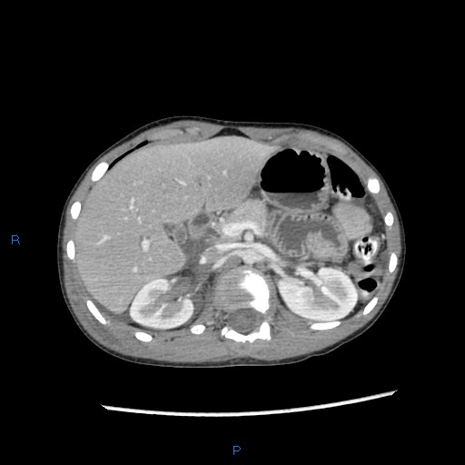 File:Chance fracture with duodenal and pancreatic lacerations (Radiopaedia 43477-46864 A 5).jpg