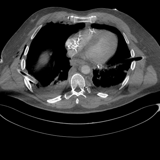 File:Chest multitrauma - aortic injury (Radiopaedia 34708-36147 A 198).png
