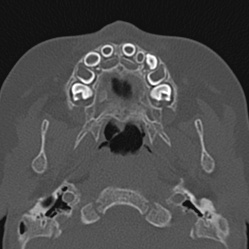 Choanal atresia (Radiopaedia 88525-105975 Axial bone window 8).jpg