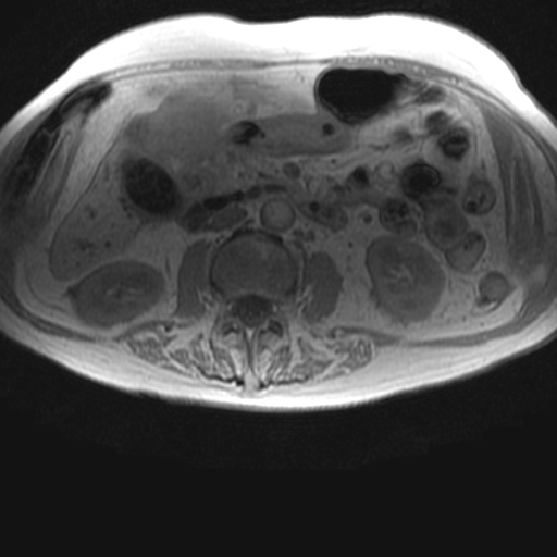File:Cholangiocarcinoma - mass-forming pattern (Radiopaedia 16017-15677 T1 in-phase 23).jpg