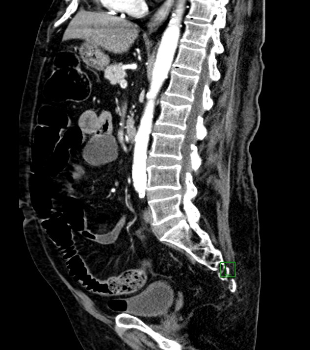 Cholangiocarcinoma with cerebral metastases (Radiopaedia 83519-98629 F 59).jpg