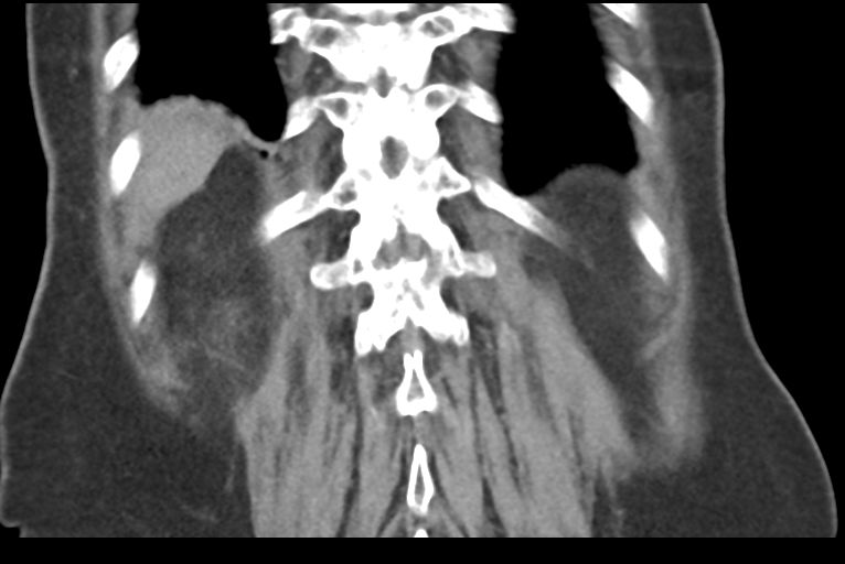 File:Cholecystitis - obstructive choledocholitiasis (CT intravenous cholangiography) (Radiopaedia 43966-47479 Coronal 36).png