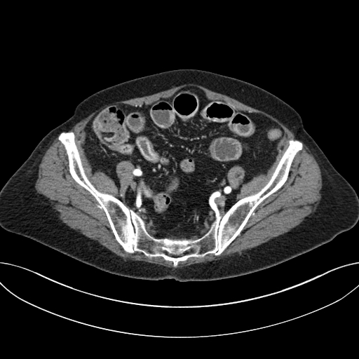 File:Cholecystoduodenal fistula due to calculous cholecystitis with gallstone migration (Radiopaedia 86875-103077 A 56).jpg
