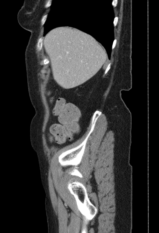 Cholecystoduodenal fistula due to calculous cholecystitis with gallstone migration (Radiopaedia 86875-103077 F 51).jpg