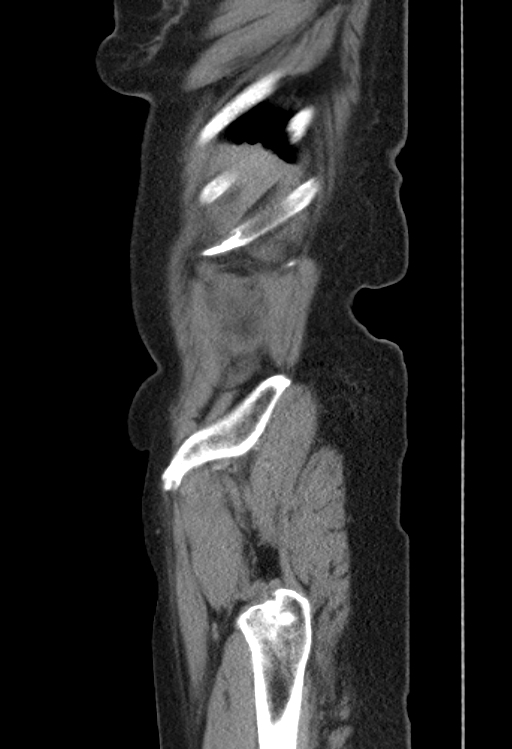 Cholecystoduodenal fistula due to calculous cholecystitis with gallstone migration (Radiopaedia 86875-103077 F 56).jpg