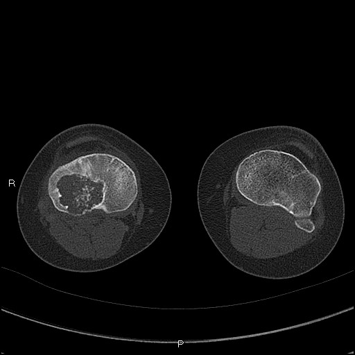 Chondroblastoma (Radiopaedia 62721-71030 Axial bone window 53).jpg