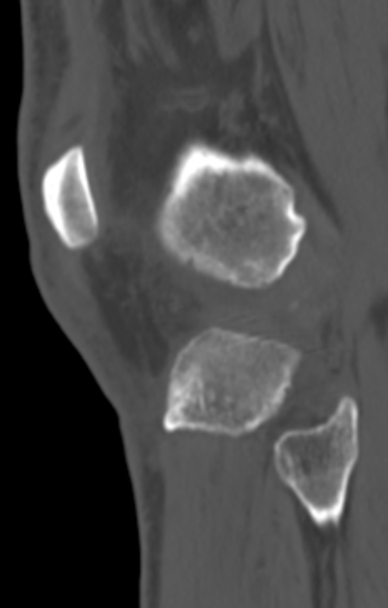 Chondrocalcinosis (Radiopaedia 82862-97173 Sagittal bone window 56).jpg