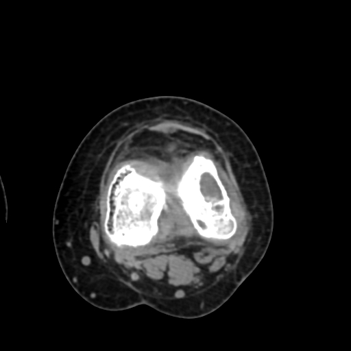 Chondrosarcoma - femur (Radiopaedia 64187-72954 Axial non-contrast 53).jpg