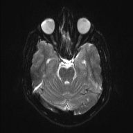 File:Chondrosarcoma - sphenoid wing (Radiopaedia 58259-67947 Axial DWI 7).jpg