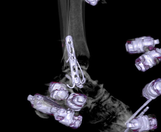 File:Chopart fracture (Radiopaedia 35347-36861 3D MPR bone window 30).jpg
