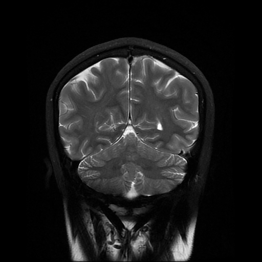 File:Chordoid glioma of third ventricle (Radiopaedia 91612-109340 Coronal T2 24).jpg