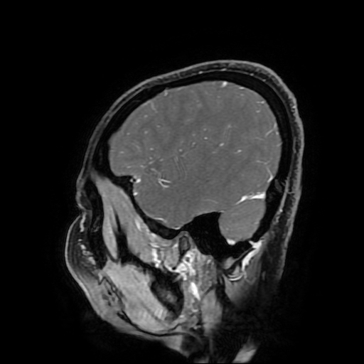 File:Chordoid glioma of third ventricle (Radiopaedia 91612-109340 F 165).jpg