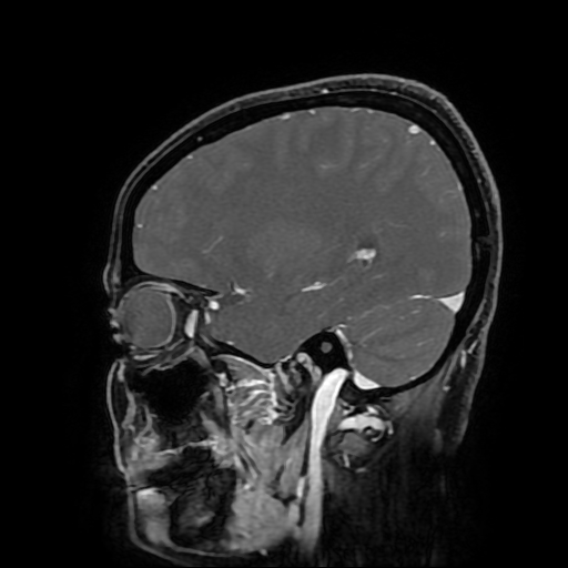 File:Chordoid glioma of third ventricle (Radiopaedia 91612-109340 F 69).jpg