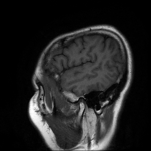 File:Chordoid glioma of third ventricle (Radiopaedia 91612-109340 Sagittal T1 2).jpg