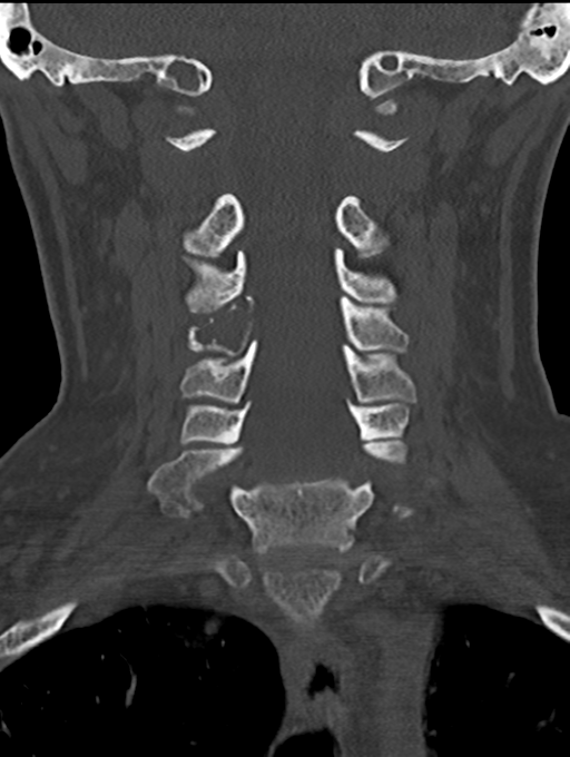 Chordoma (C4 vertebra) (Radiopaedia 47561-52188 Coronal bone window 27).png