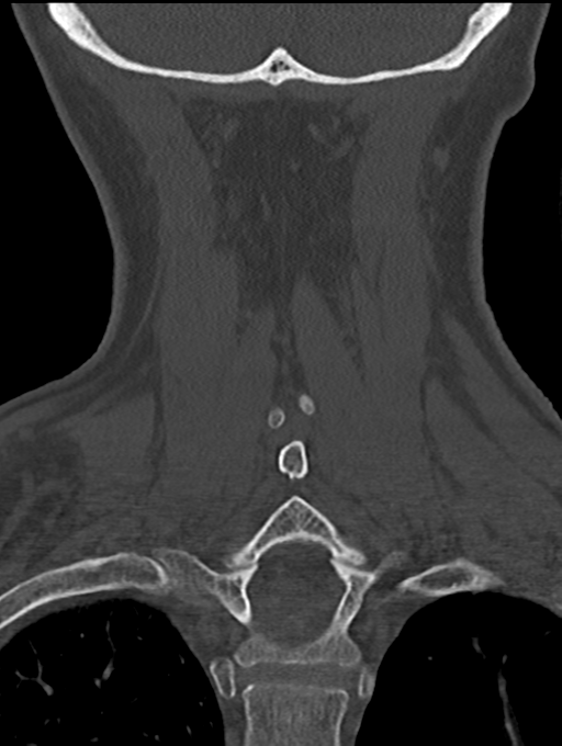 Chordoma (C4 vertebra) (Radiopaedia 47561-52188 Coronal bone window 47).png