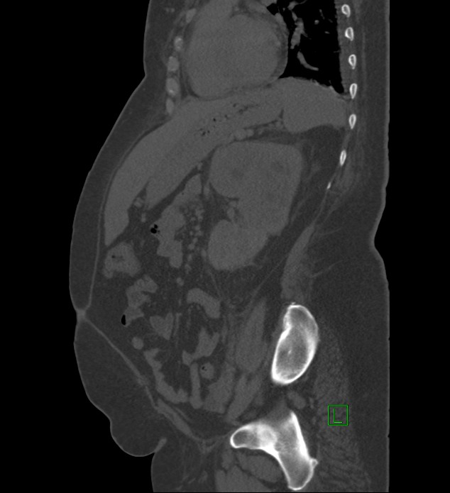 Chromophobe renal cell carcinoma (Radiopaedia 84239-99519 Sagittal bone window 36).jpg