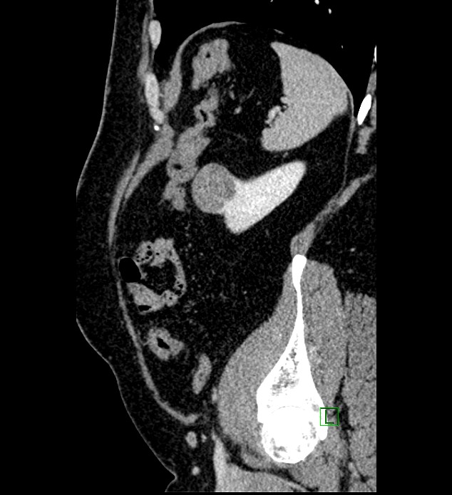 Chromophobe renal cell carcinoma (Radiopaedia 84286-99573 I 35).jpg