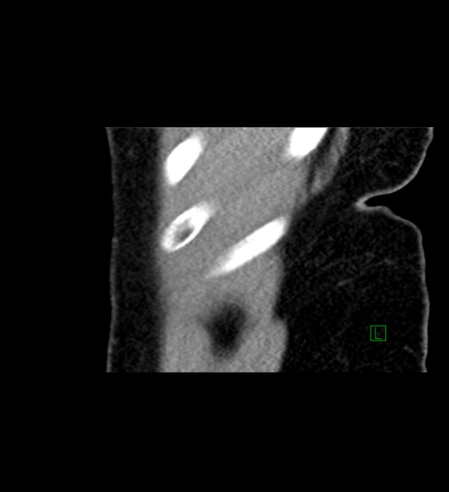 Chromophobe renal cell carcinoma (Radiopaedia 84290-99582 D 91).jpg