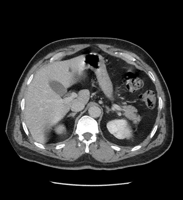Chromophobe renal cell carcinoma (Radiopaedia 86879-103083 C 35).jpg