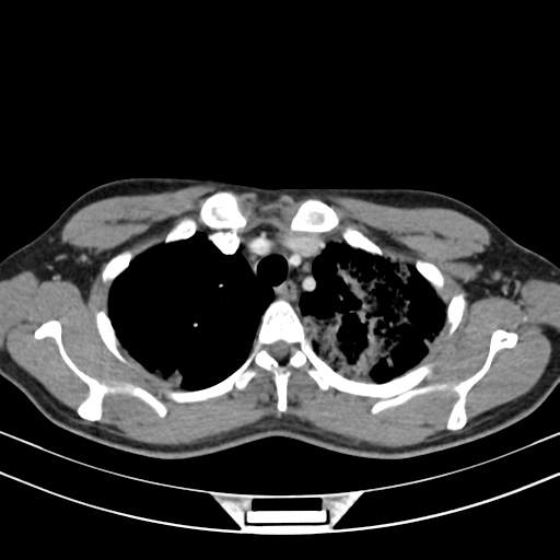 Chronic eosinophilic pneumonia (Radiopaedia 39331-41587 Axial C+ delayed 31).png