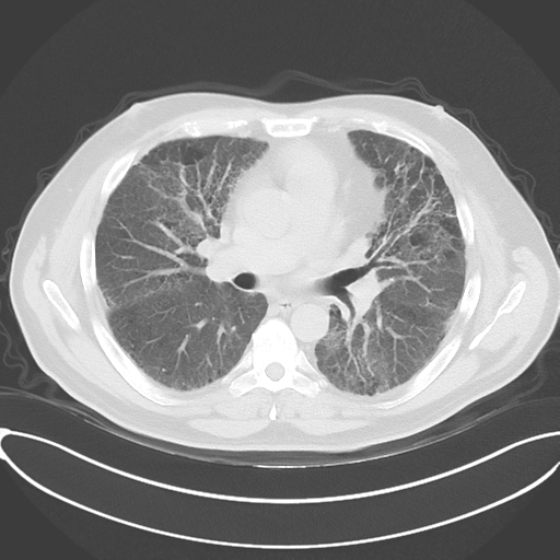 Chronic hypersensitivity pneumonitis (Radiopaedia 48107-52922 Axial lung window 31).png