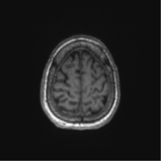 Chronic hypertensive encephalopathy (Radiopaedia 72844-83495 Axial T1 12).png