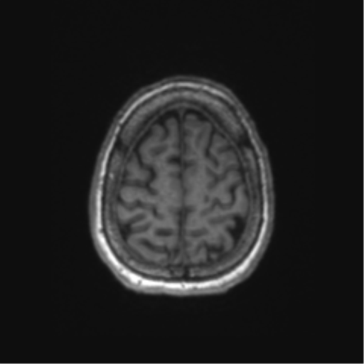 Chronic hypertensive encephalopathy (Radiopaedia 72844-83495 Axial T1 13).png