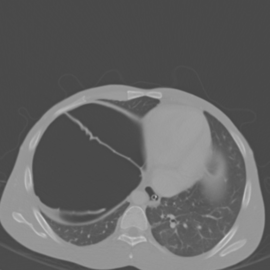 Chronic large bowel pseudo-obstruction (Radiopaedia 43181-46492 Axial bone window 28).jpg