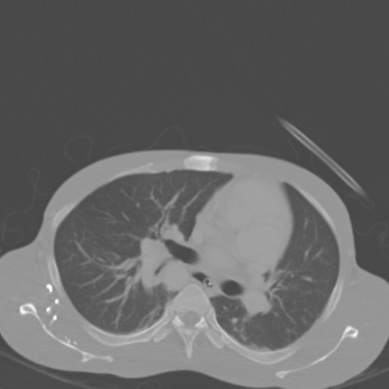Chronic large bowel pseudo-obstruction (Radiopaedia 43181-46492 Axial bone window 9).jpg