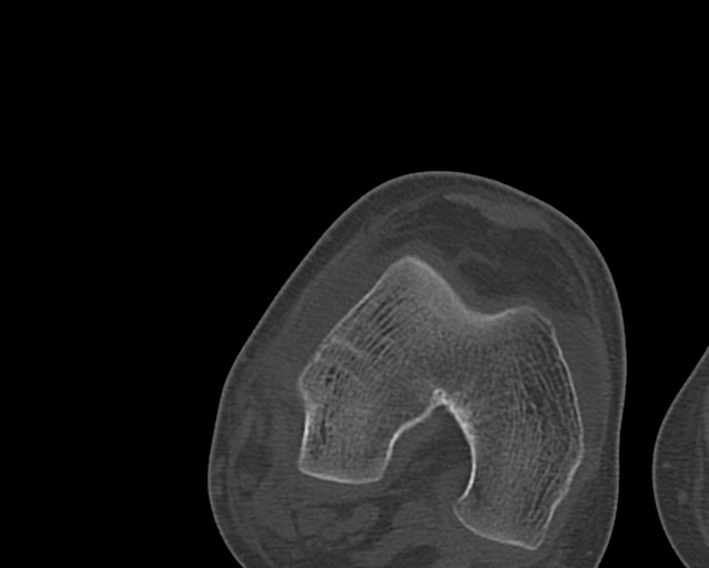 File:Chronic ostemyelitis of the femur with long sinus tract (Radiopaedia 74947-85982 Axial bone window 220).jpg