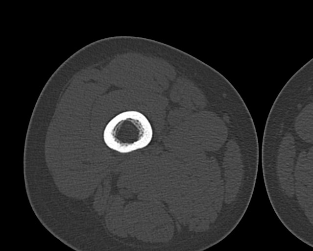 Chronic ostemyelitis of the femur with long sinus tract (Radiopaedia 74947-85982 Axial bone window 67).jpg