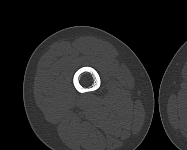 File:Chronic ostemyelitis of the femur with long sinus tract (Radiopaedia 74947-85982 Axial bone window 87).jpg
