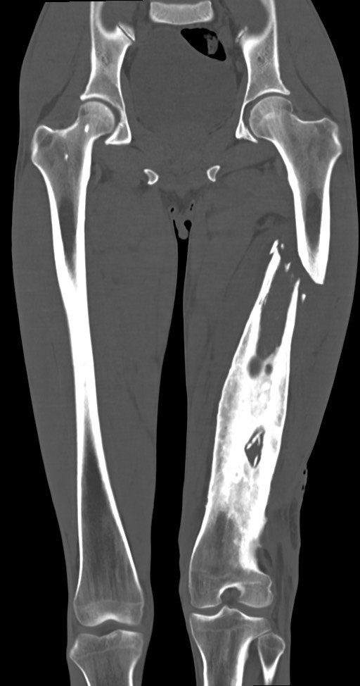 Chronic osteomyelitis (with sequestrum) (Radiopaedia 74813-85822 Coronal non-contrast 29).jpg