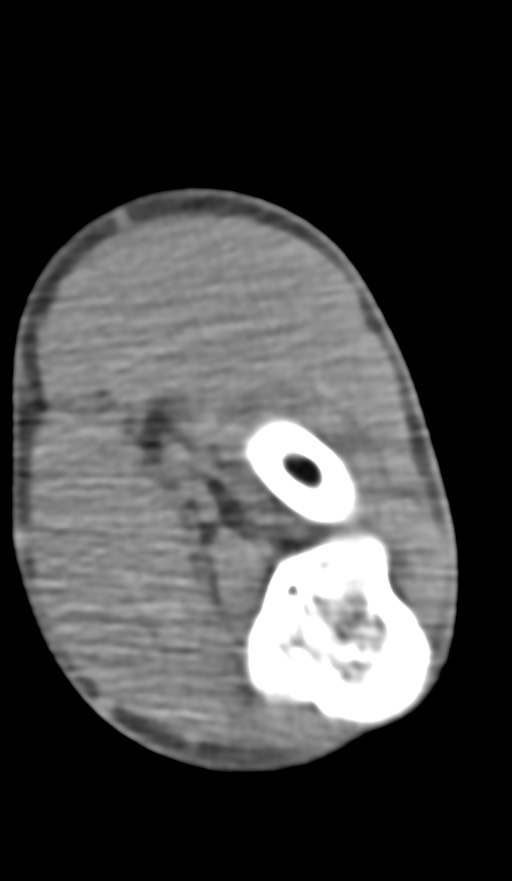 Chronic osteomyelitis of the distal humerus (Radiopaedia 78351-90971 Axial non-contrast 105).jpg