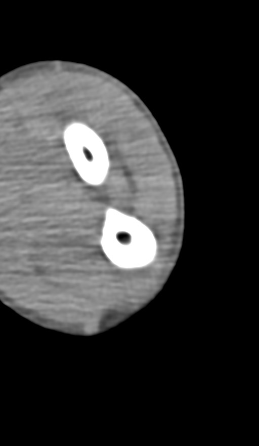 Chronic osteomyelitis of the distal humerus (Radiopaedia 78351-90971 Axial non-contrast 123).jpg