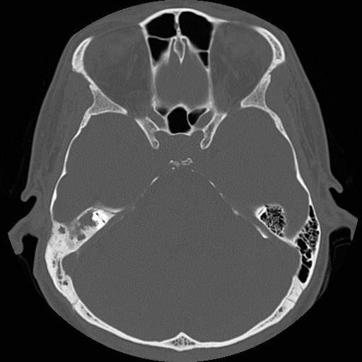 File:Chronic otomastoiditis (Radiopaedia 27138-27309 Axial bone window 47).jpg