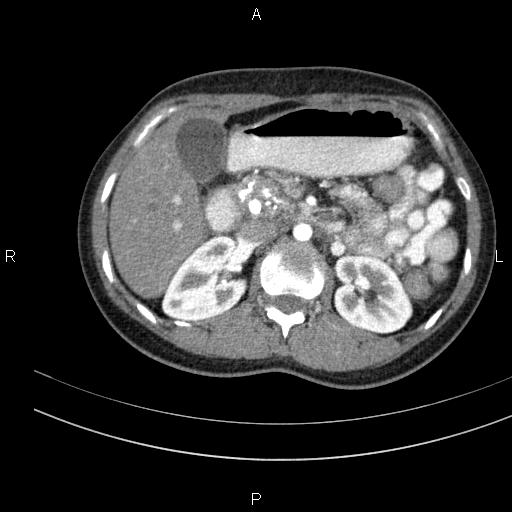 Chronic pancreatitis (Radiopaedia 64576-73450 B 56).jpg