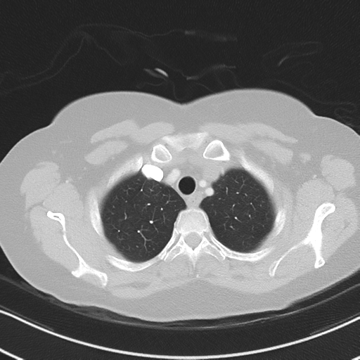 Chronic pulmonary embolus (Radiopaedia 39129-41341 Axial lung window 12).png