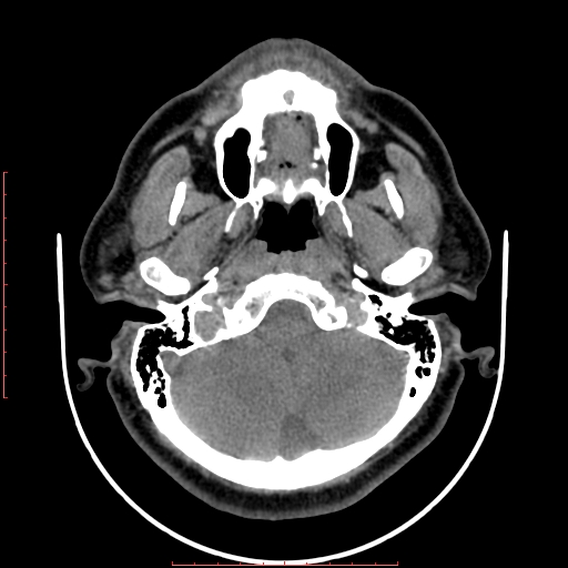 Chronic submandibular sialolithiasis (Radiopaedia 69817-79814 Axial non-contrast 22).jpg