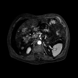 Cirrhosis and hepatocellular carcinoma in the setting of hemochromatosis (Radiopaedia 75394-86594 Axial T1 C+ fat sat 128).jpg