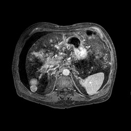 Cirrhosis and hepatocellular carcinoma in the setting of hemochromatosis (Radiopaedia 75394-86594 Axial T1 C+ fat sat 305).jpg