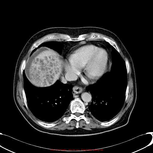 Cirrhosis and hepatocellular carcinoma in the setting of hemochromatosis (Radiopaedia 75394-86595 B 14).jpg